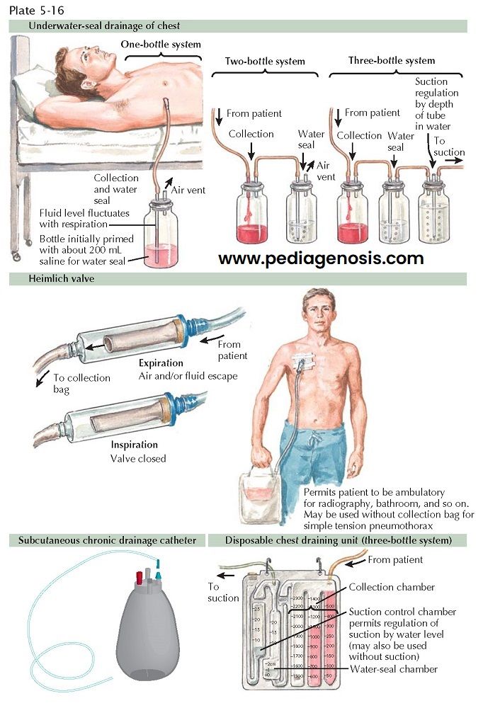 Chest Tube System